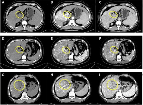 liver cancer near rocklin